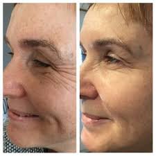 Wrinkle Reduction