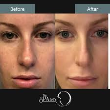 PhotoFacial Skin Glow